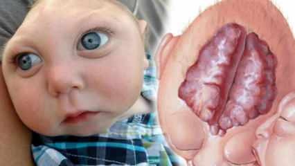 Hvad er Anencephaly? Hvad er symptomerne på Anencephaly hos spædbørn og børn? Anencefali forårsager ...