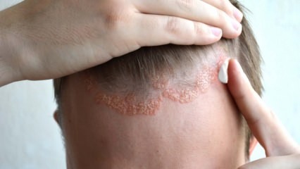 Hvad er symptomerne på seboreisk dermatitis, og hvem vises den? Fødevarer, der udløser sygdommen