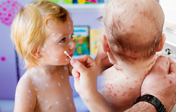Symptomer på skoldkopper i spædbarnet og barndommen