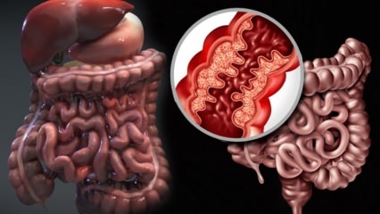 Hvad er Crohns sygdom? Hvad er symptomerne på Crohns sygdom? Er der en kur mod Crohn?