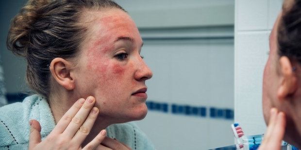disse vises på huden hos en person med en kold allergi