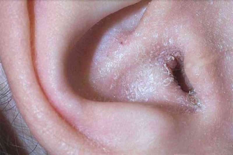 Hvad forårsager skrælning bag øret, og hvordan passerer det? Den endelige løsning for eksem bag øret ...
