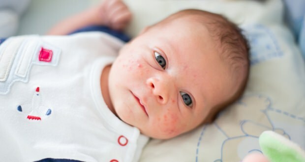 Hvordan passerer acne på babyens ansigt? Acne (Milia) tørremetoder