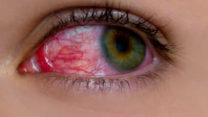 Hvad forårsager øjenallergi? Hvad er symptomerne på øjenallergi? Hvad er godt for øjenallergier? 