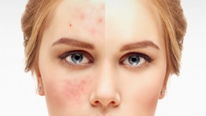 Cremer på apoteket, der har den mest effektive acne 2020