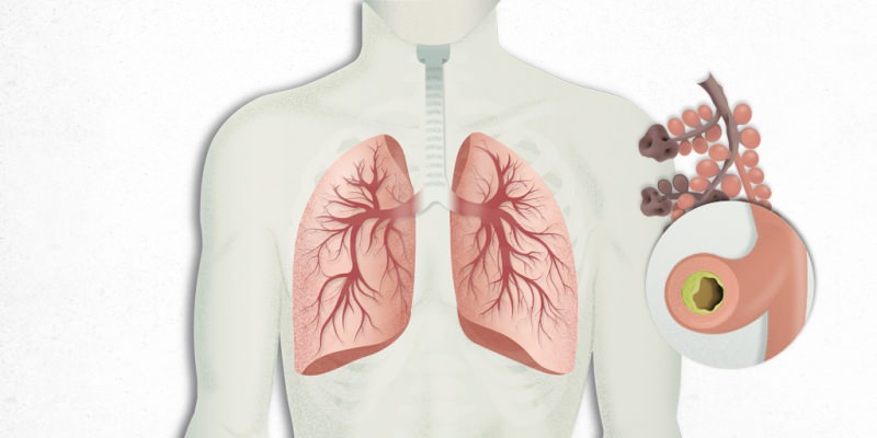 den virus, der sætter sig i lungerne, er blandet med lungebetændelse