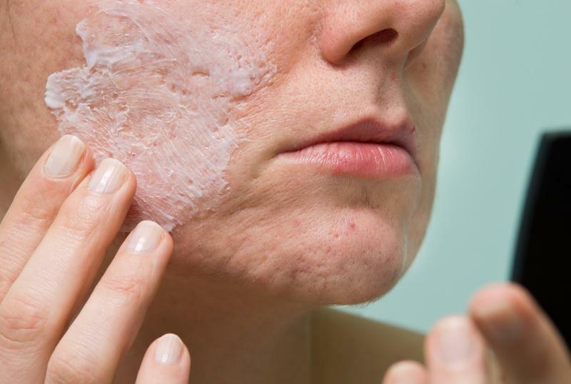 Hvad forårsager betændt acne, og hvordan forsvinder det? Maske, der tørrer betændt acne