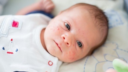 Hvordan passerer acne på babyens ansigt? Acne (Milia) tørremetoder