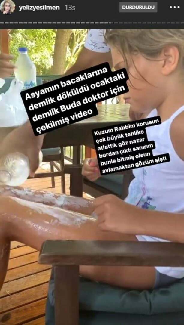Kogende vand blev hældt på benene af Yeliz Yeşilmens datter