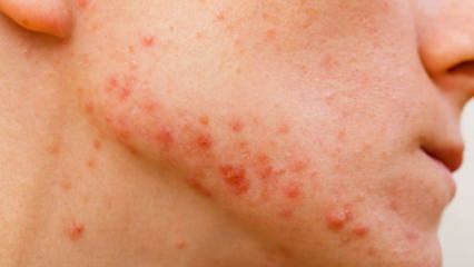Hvordan passerer cystisk acne? Hvad er godt for cystisk acne?