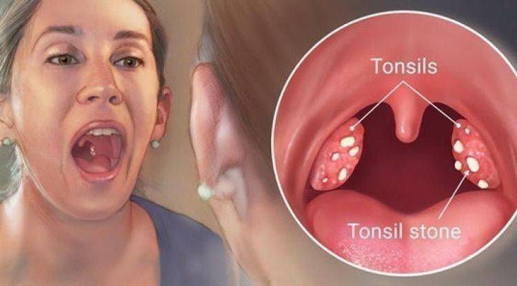 tonsilitis kaldes hævelse af mandlerne