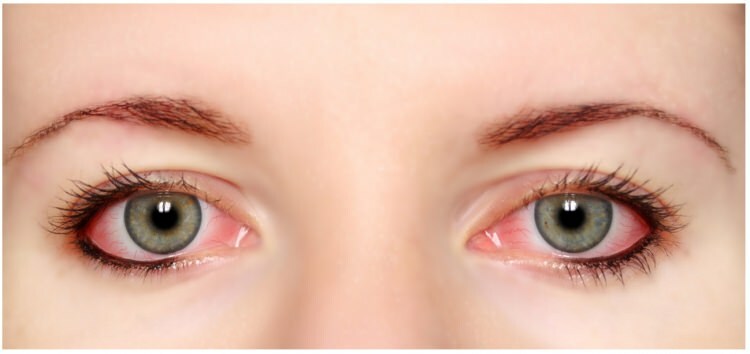 Har mascara og eyeliner allergi i øjnene?