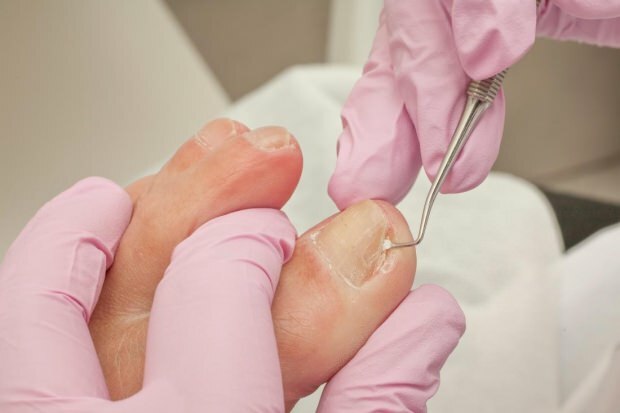 Hvad forårsager indgroede tånegle, og hvad er symptomerne? Naturlige måder, der er gode til indgroede negle ...