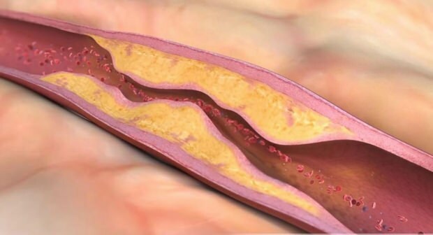 Hvad forårsager aterosklerose? Hvor mange typer vaskulær okklusion er der?