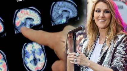 Hvad er stiff-person syndrom? Celine Dion