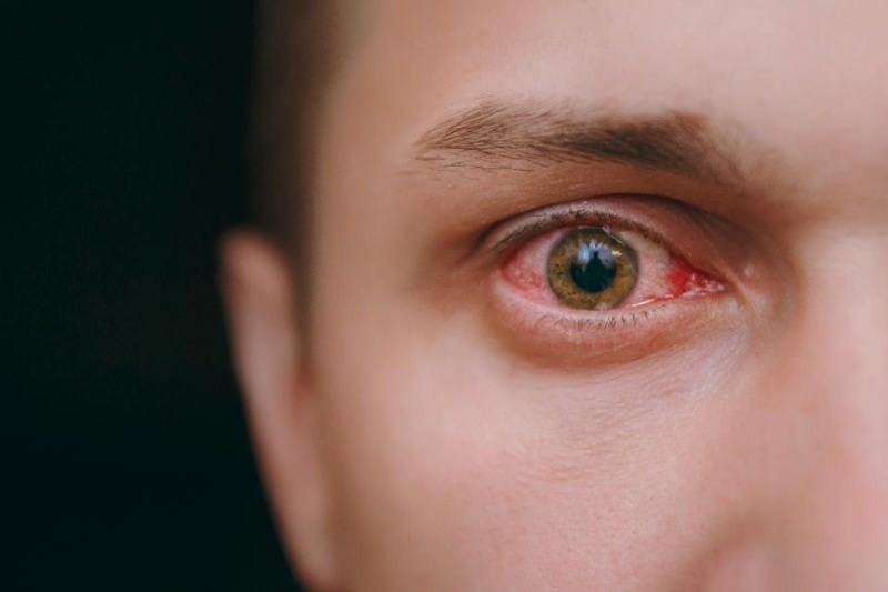 øjenvanding, blødning og kløende coronavirus-symptomer