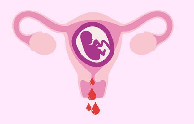 årsager til blødning under graviditet