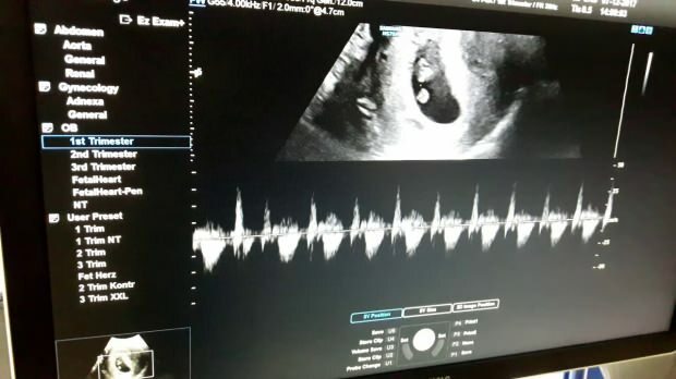 Hvornår høres hjerterytmen fra babyen i moderens livmoder? Hvis babyens hjerterytme ikke høres ...