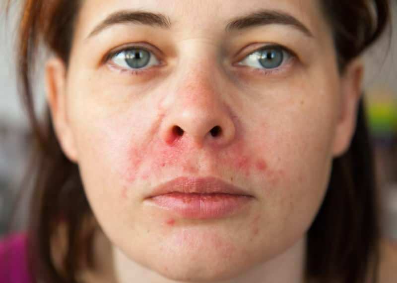Hvorfor vises acne omkring læben? Hvordan behandles perioral dermatitis?