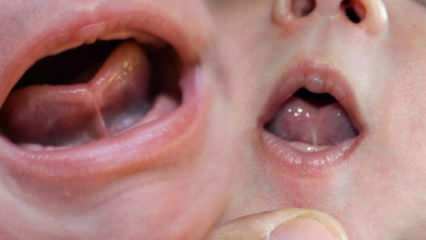 Hvad er tungebindingen (Ankyloglossi) hos spædbørn? Tunge bindingssymptomer og behandling ...