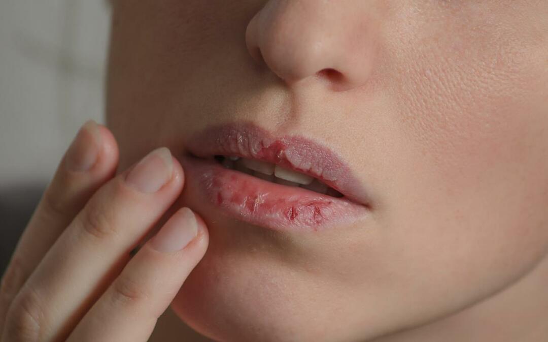 Hvad forårsager mørke læber? Hvordan behandles mørkfarvning af læber eller blå mærker?