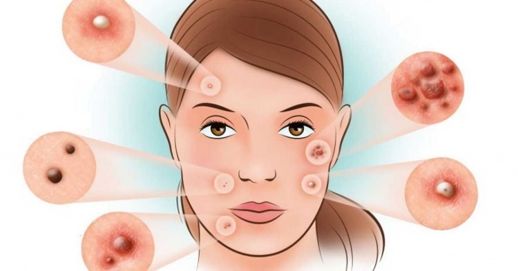 Hvordan behandles acne?