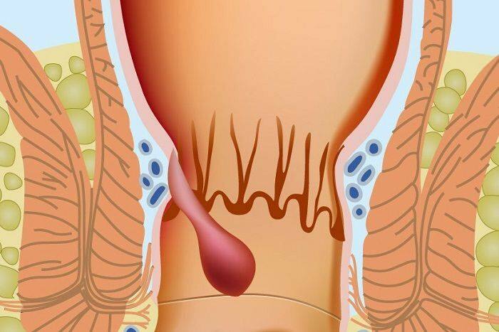 Hvordan hæmorroider forekommer i den anale del 