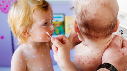 Hvordan forstås skoldkopper i barndommen og i barndommen? Skoldkopper symptomer og behandling