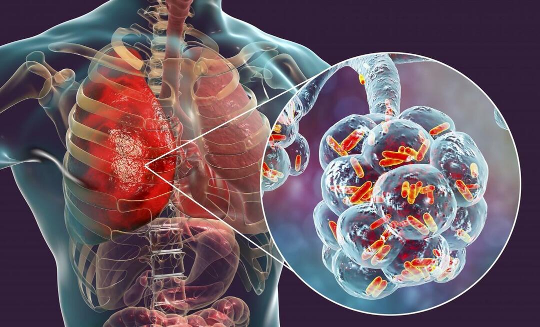 Hvad er lungebetændelse, og hvad er dens symptomer? Hvordan behandles den nye epidemiske lungebetændelsesvirus?