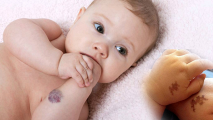 Forårsager fødselsmærke hos babyer, er det permanent? Hvilke typer fødselsmærker er der? Kur fra Saracoglu