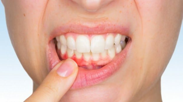 Almindelige tandkødsproblemer