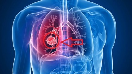 Symptomer på lungekræft: stadier af lungekræft!
