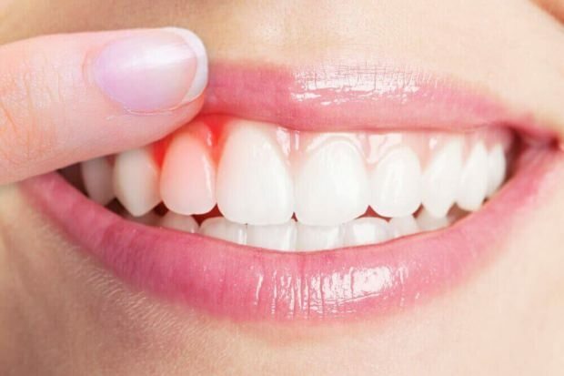 Hvad forårsager tandkødsblødning?