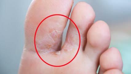 Hvad er fodsvamp? Hvad er symptomerne på atletens fod? Behandling af fodsvamp 