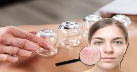 Hvad er fordelene ved cupping for hud og hår? Kan cupping helbrede acne?