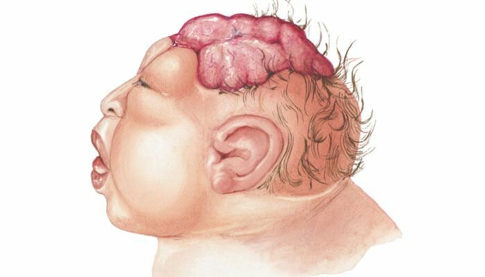 Hvad er Anencephaly? Hvad er symptomerne på Anencephaly hos spædbørn og børn? Anencefali forårsager ...