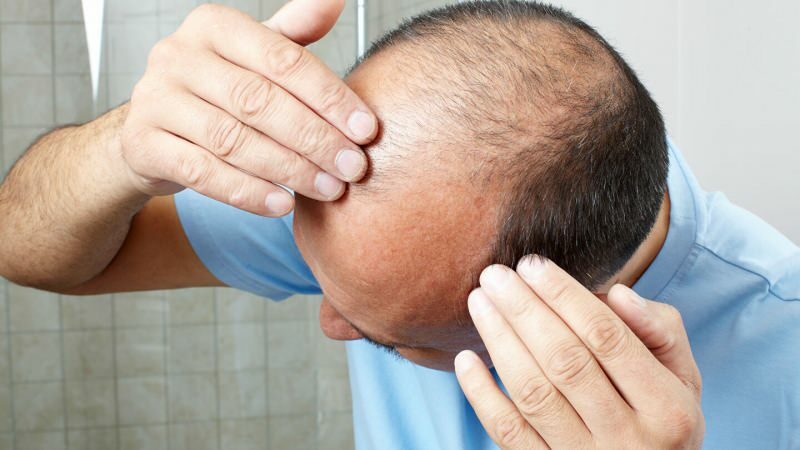 Forebygger hårtransplantation ghusl?