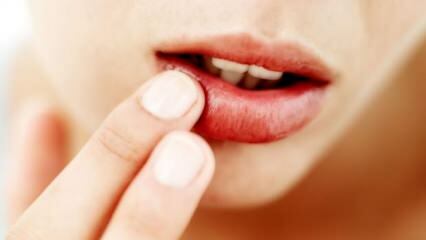 Hvad er godt til læbe krakning?