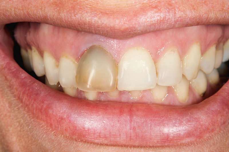 tænder mørkere kan nogle gange koncentrere sig om en tand