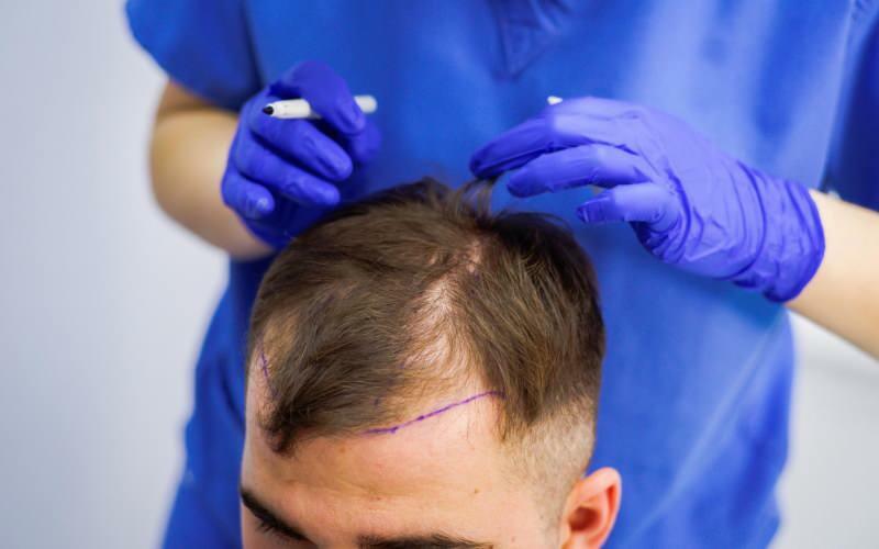 Er det tilladt at transplantere hår til behandling af hårtab? Hvad er protetisk hår? Hindrer protetisk hår ghusl?