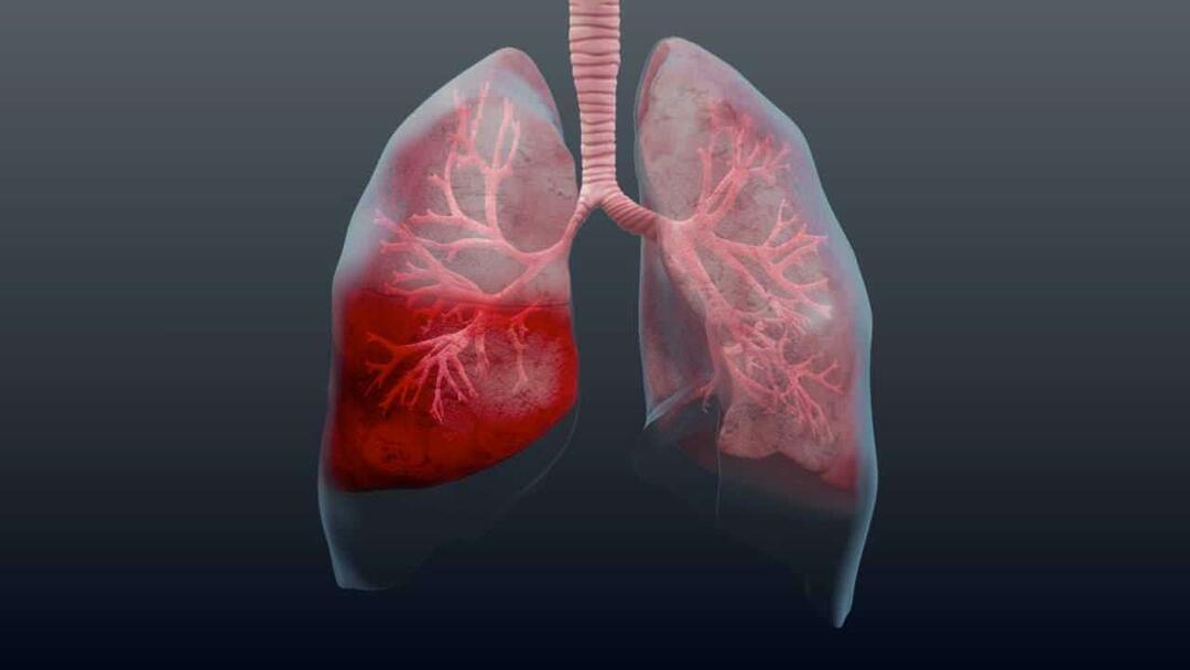 Hvad er lungebetændelse, og hvad er dens symptomer? Hvordan behandles den nye epidemiske lungebetændelsesvirus?