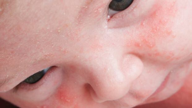 Hvordan passerer acne hos spædbørn?