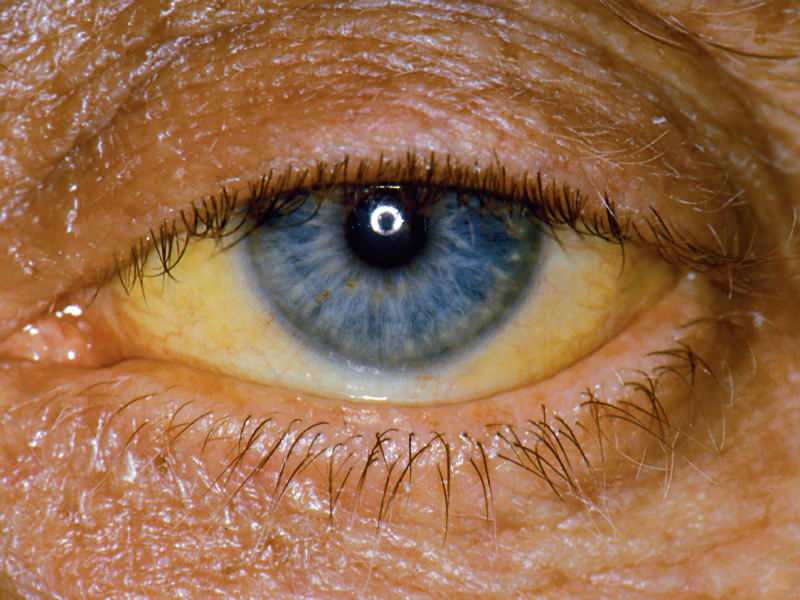 højde ved bilirubin-niveau forårsager gul farve på øjne og hud