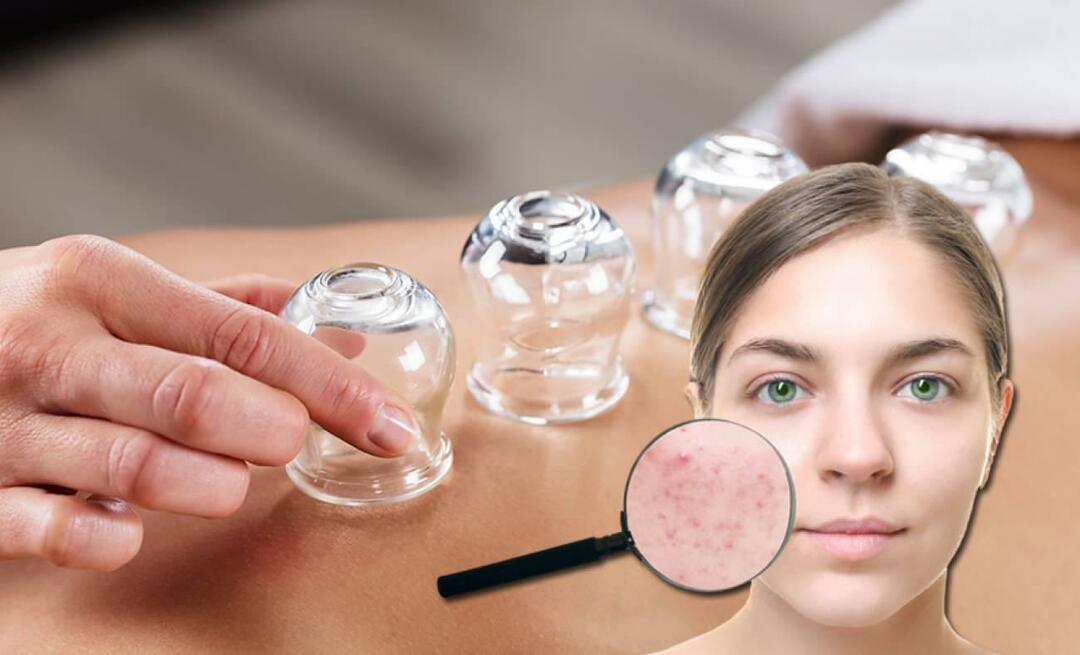 Hvad er fordelene ved cupping for hud og hår? Kan cupping helbrede acne?