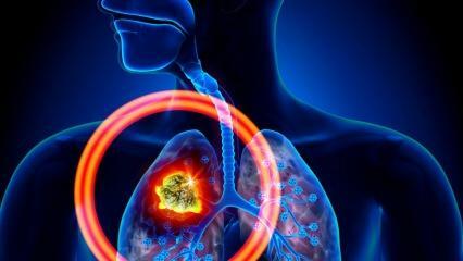 Hvad er symptomerne på lungekræft? Er der en behandling for lungekræft?