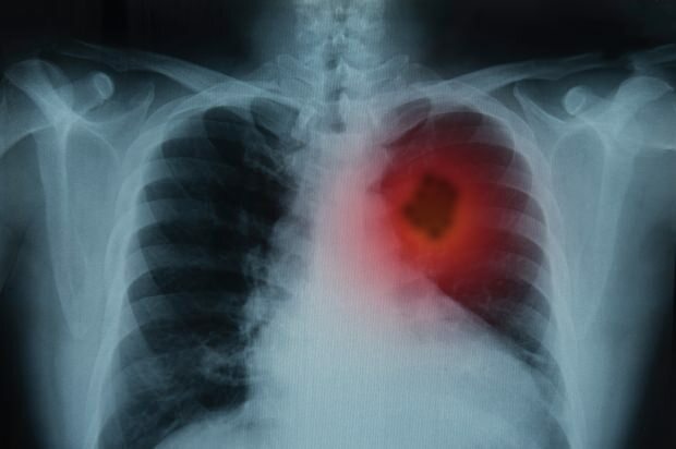 Hvad er symptomerne på lungekræft? Er der en lungekræftbehandling? For at forhindre lungekræft ...