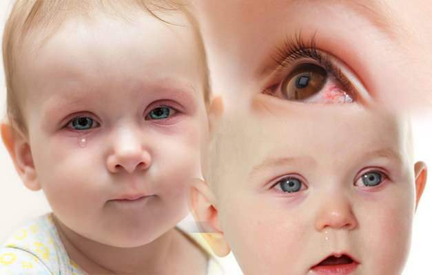 forårsager øjenblødning hos babyer