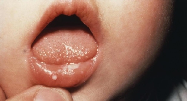 Hvordan sår en mund hos babyer