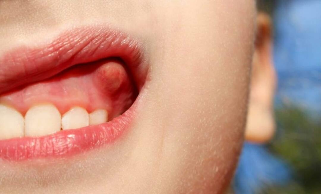 Hvorfor får tanden byld, og hvad er symptomerne? Tandbyld, hvordan behandles det?
