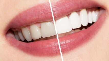 Hvad er anbefalingerne til hvide tænder? Tandblekning kur naturligt derhjemme ...